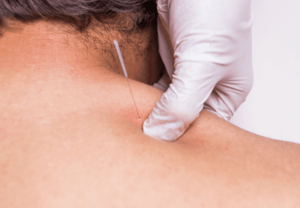 Dry needling