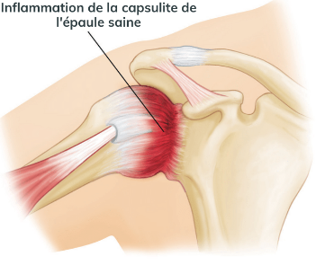 Vous souffrez d'une capsulite ? Vous avez une arthrodistension de prévue ? Prenez rendez-vous pour une séance de mobilisation dans les 2 heures post intervention
