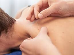 Dry needling