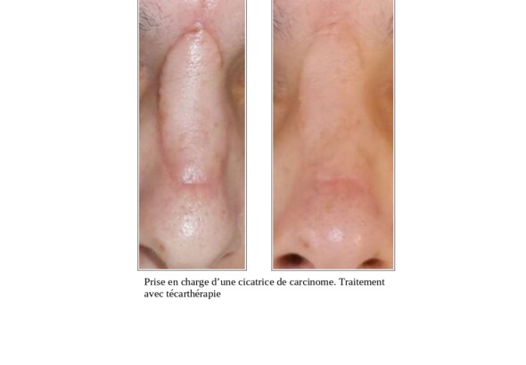 Traitement des cicatrices