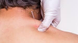 Dry needling