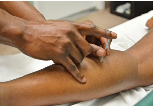 Dry Needling ou puncture sèche