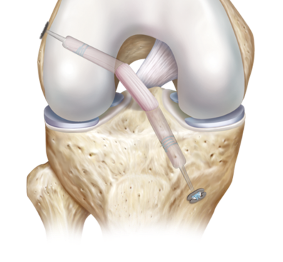 Traumatologie et Orthopédie