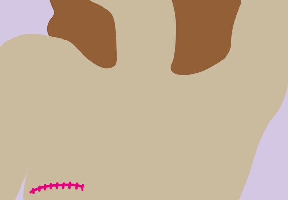 Rééducation cancer du sein